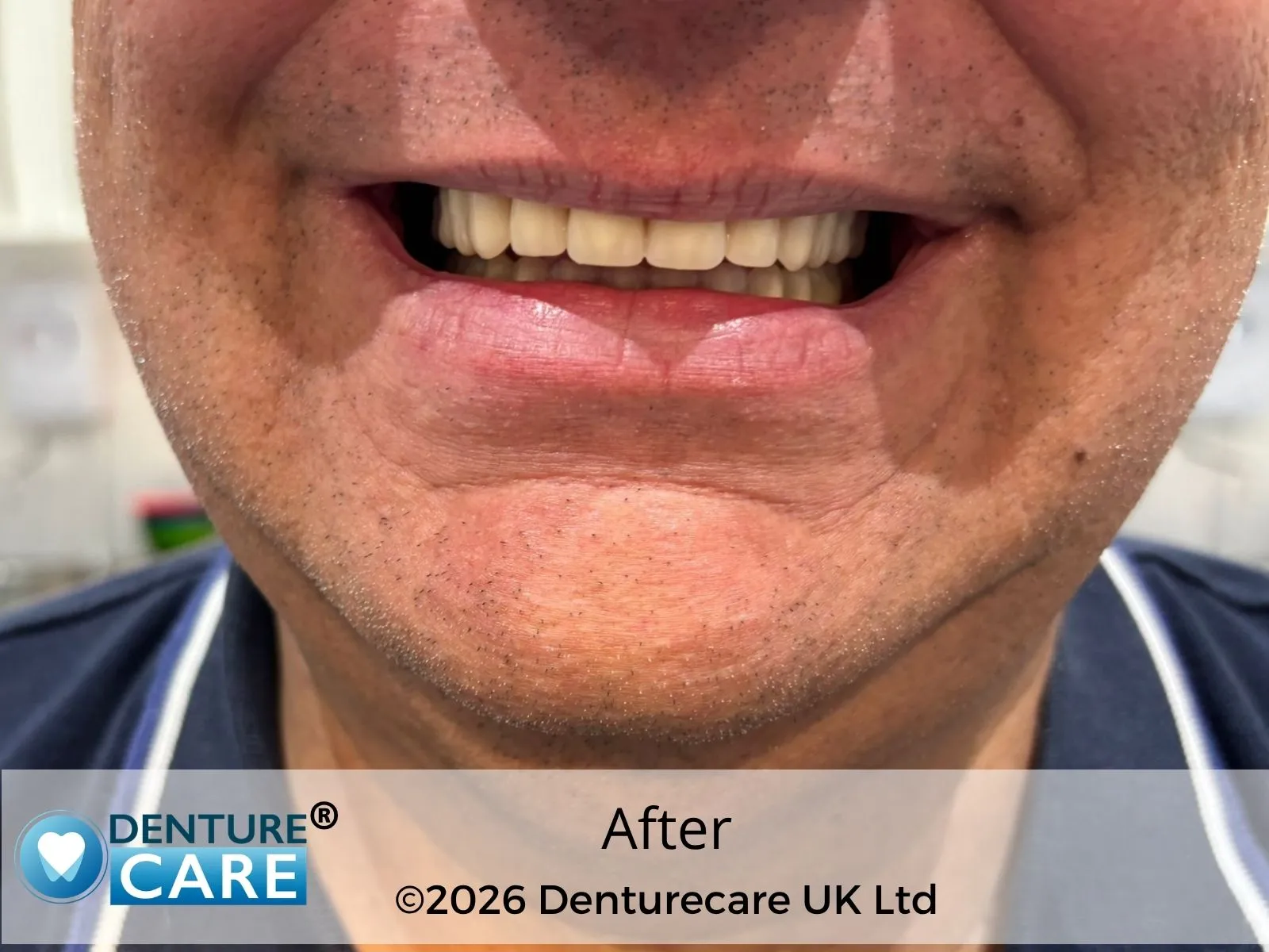 Patient’s smile after full dentures – Doncaster denture clinic