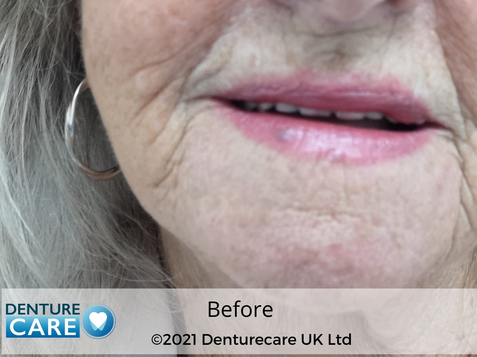 Patient’s smile before full dentures – Chesterfield denture clinic