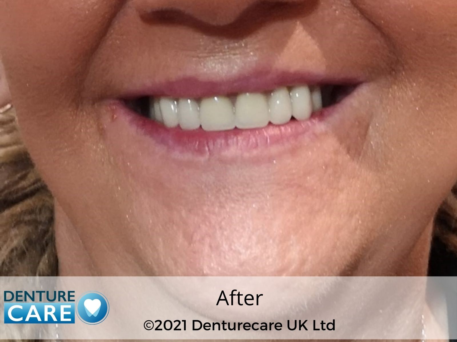 Patient’s smile after new full dentures – Doncaster denture clinic