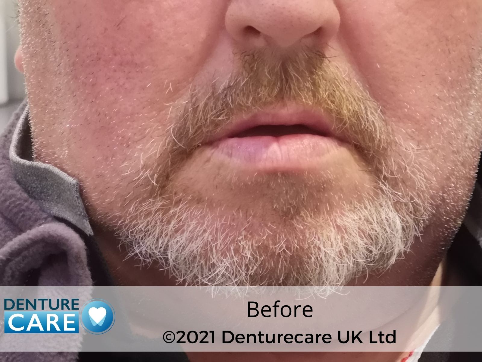 Patient’s smile before full dentures – Doncaster denture clinic