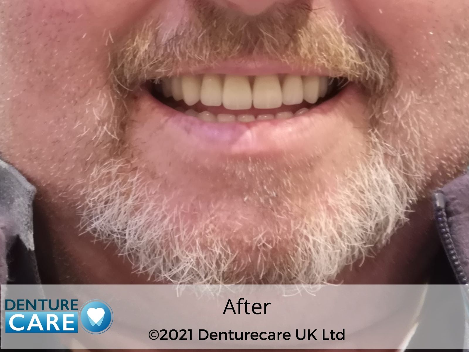 Patient’s smile after new full dentures – Doncaster denture clinic