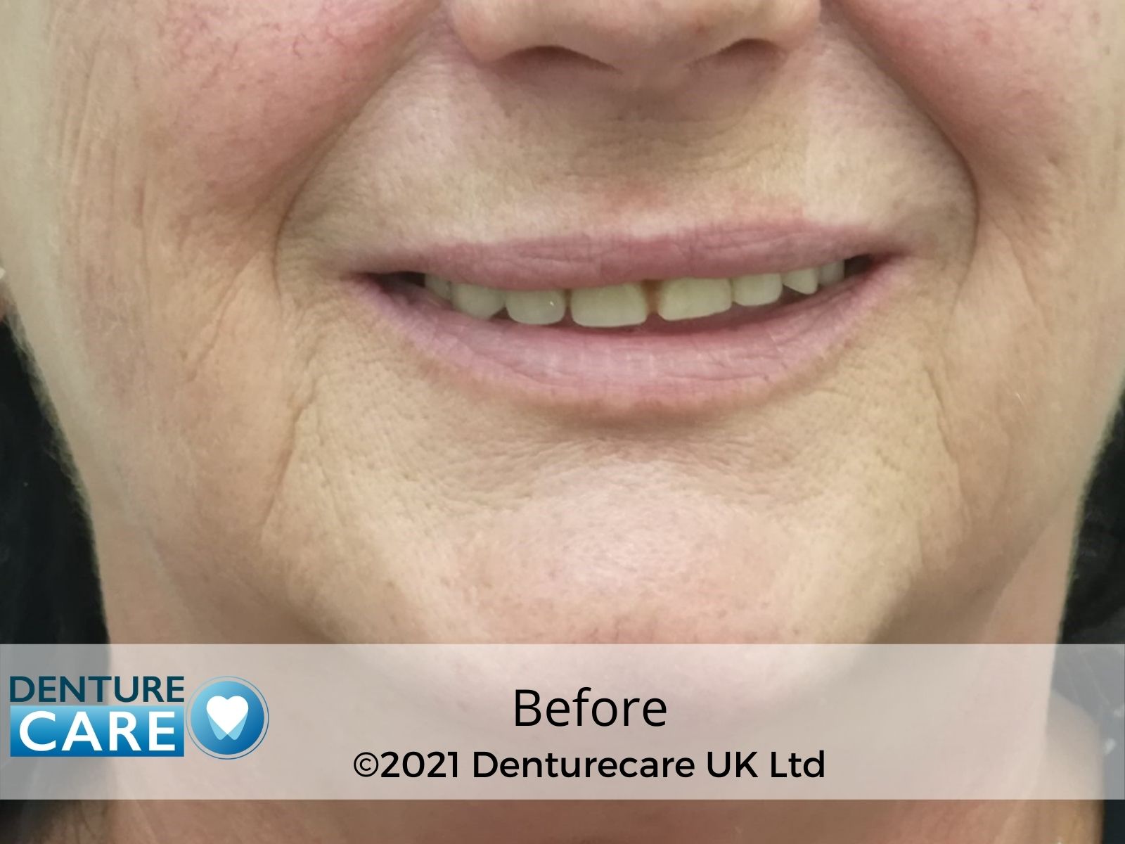 Patient’s smile before full dentures – Barnsley denture clinic