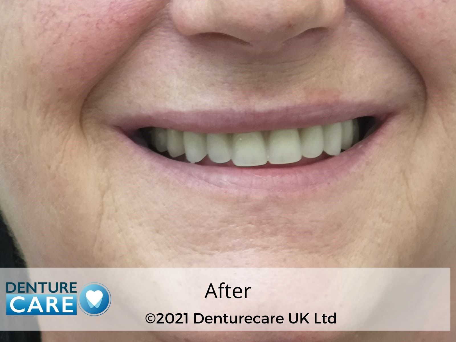 patients smile Before and after dentures Doncaster clinic