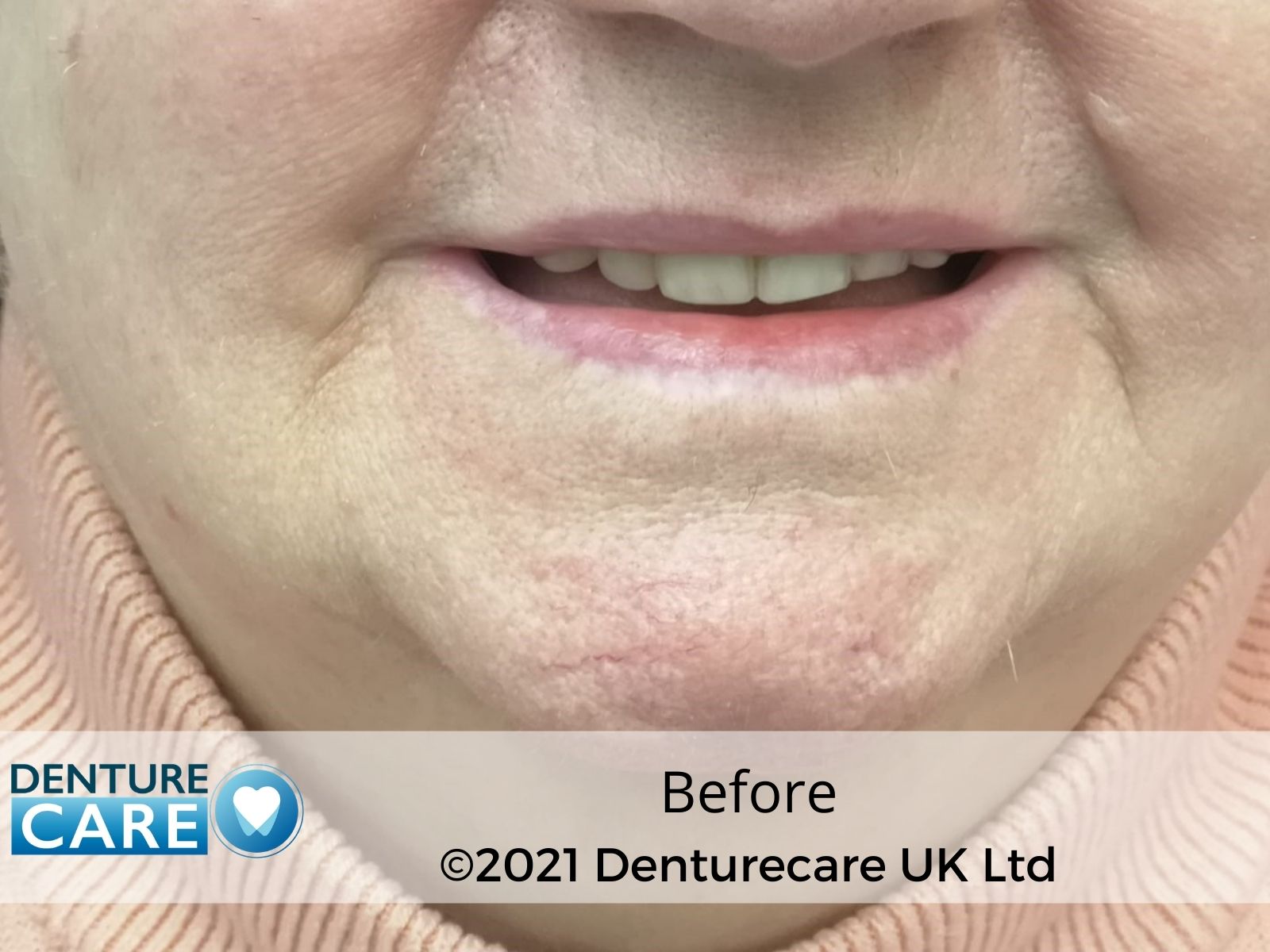 Patient’s smile before full dentures – Doncaster denture clinic