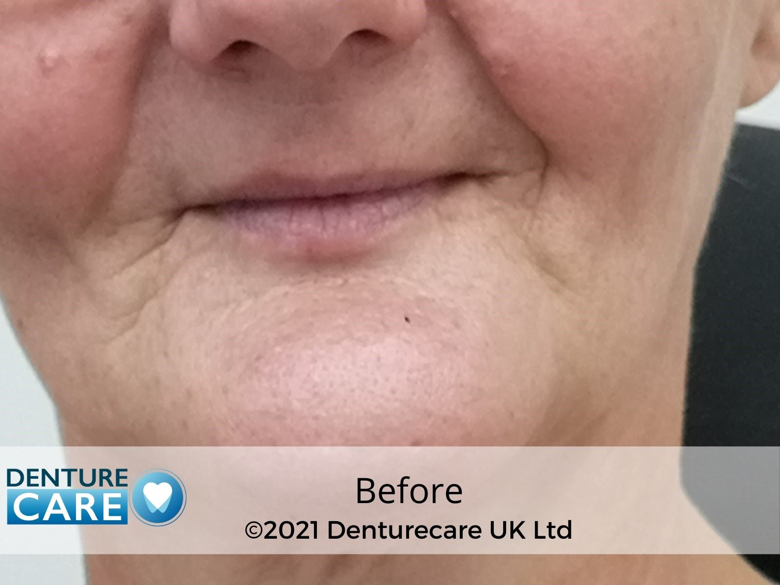 Patient’s smile before full dentures – Barnsley denture clinic