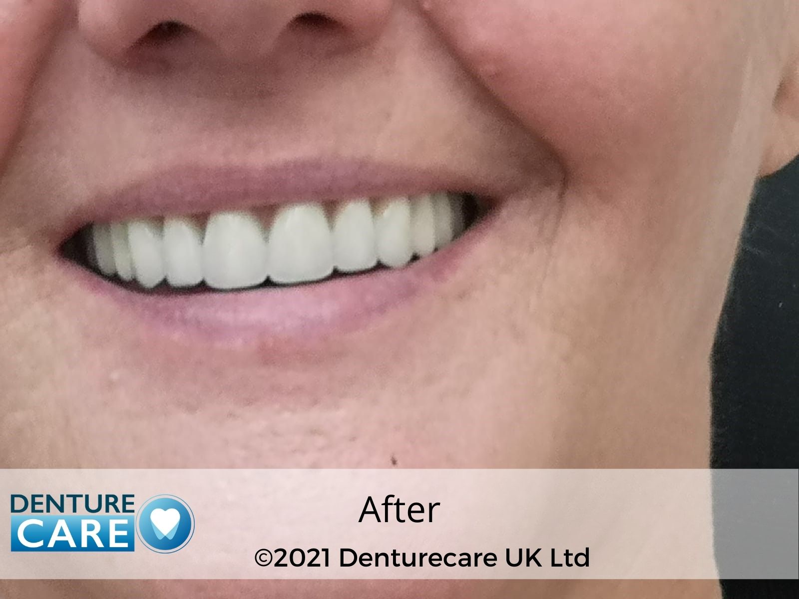 Patient’s smile after new full dentures – Barnsley denture clinic