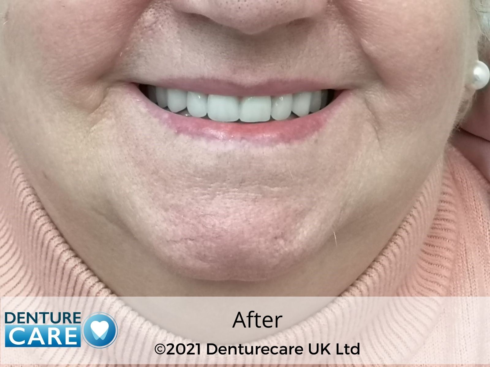 Patient’s smile after new full dentures – Doncaster denture clinic