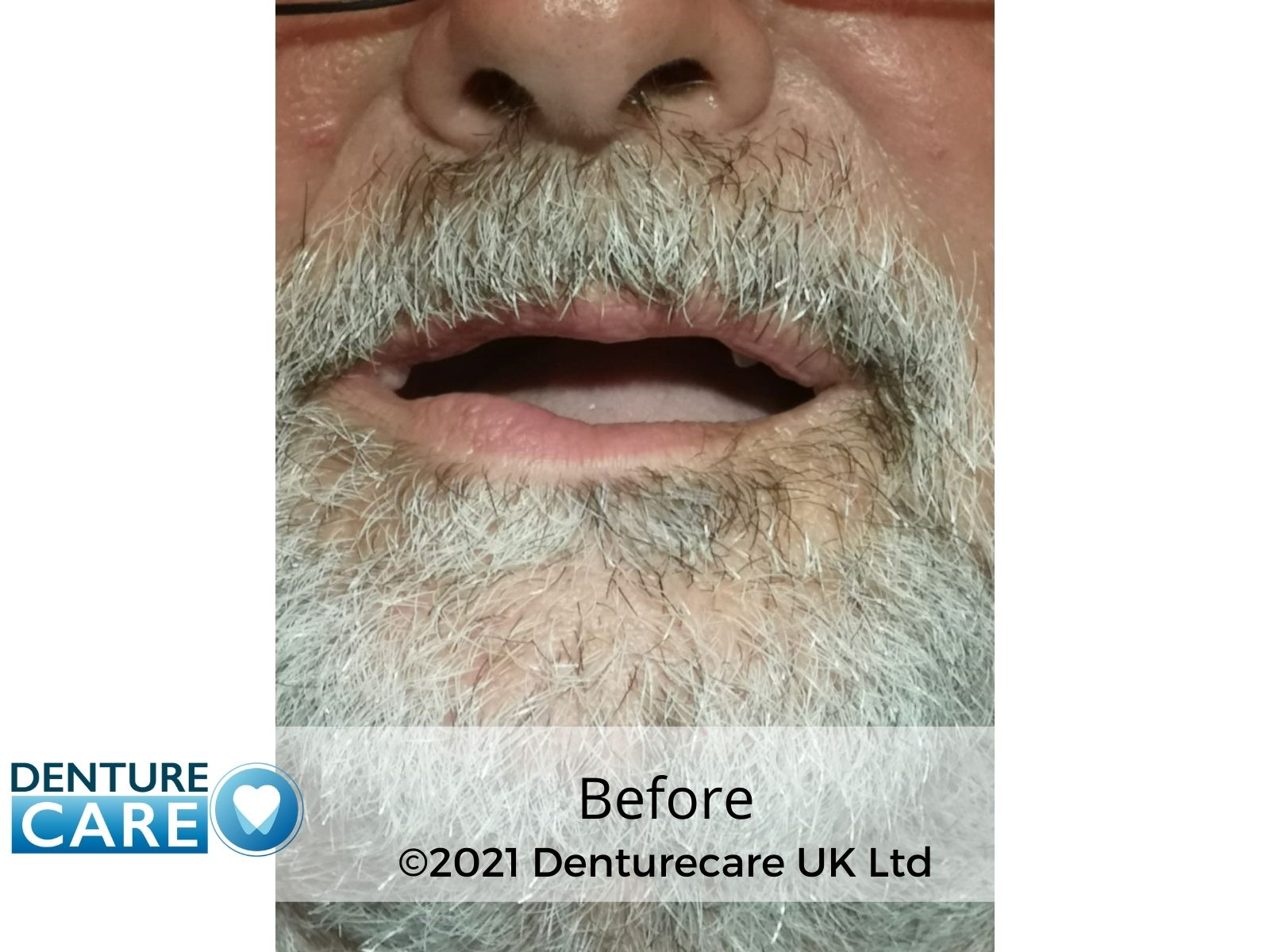 Patient’s smile before full dentures – Barnsley denture clinic