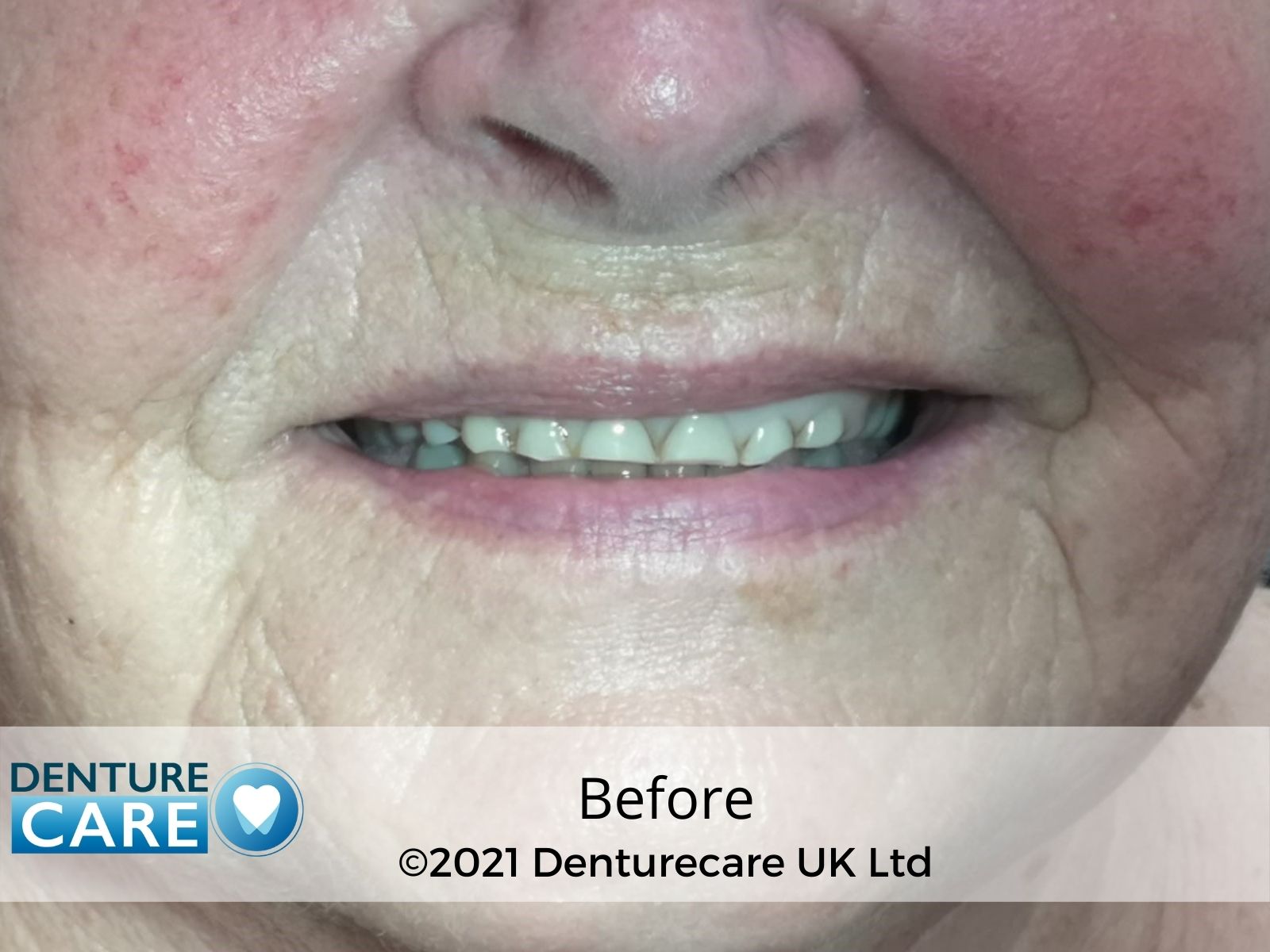 Patient’s smile before full dentures – Doncaster denture clinic