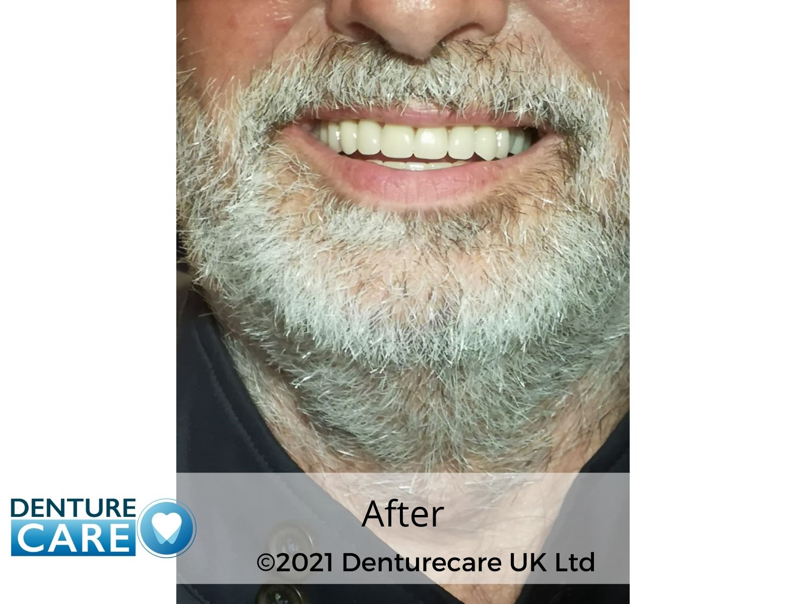 Patient’s smile after new full dentures – Barnsley denture clinic