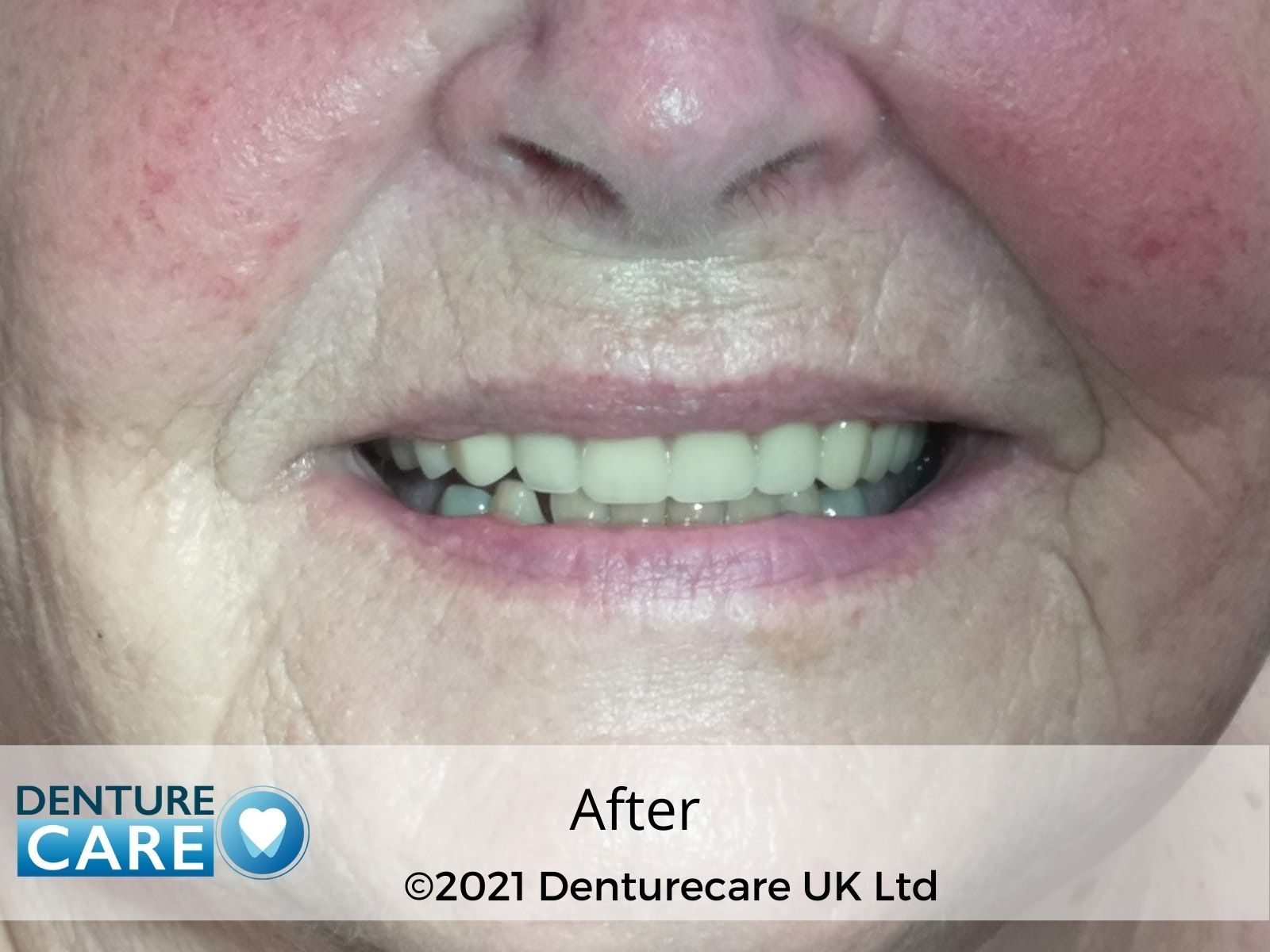 Patient’s smile after new full dentures – Doncaster denture clinic
