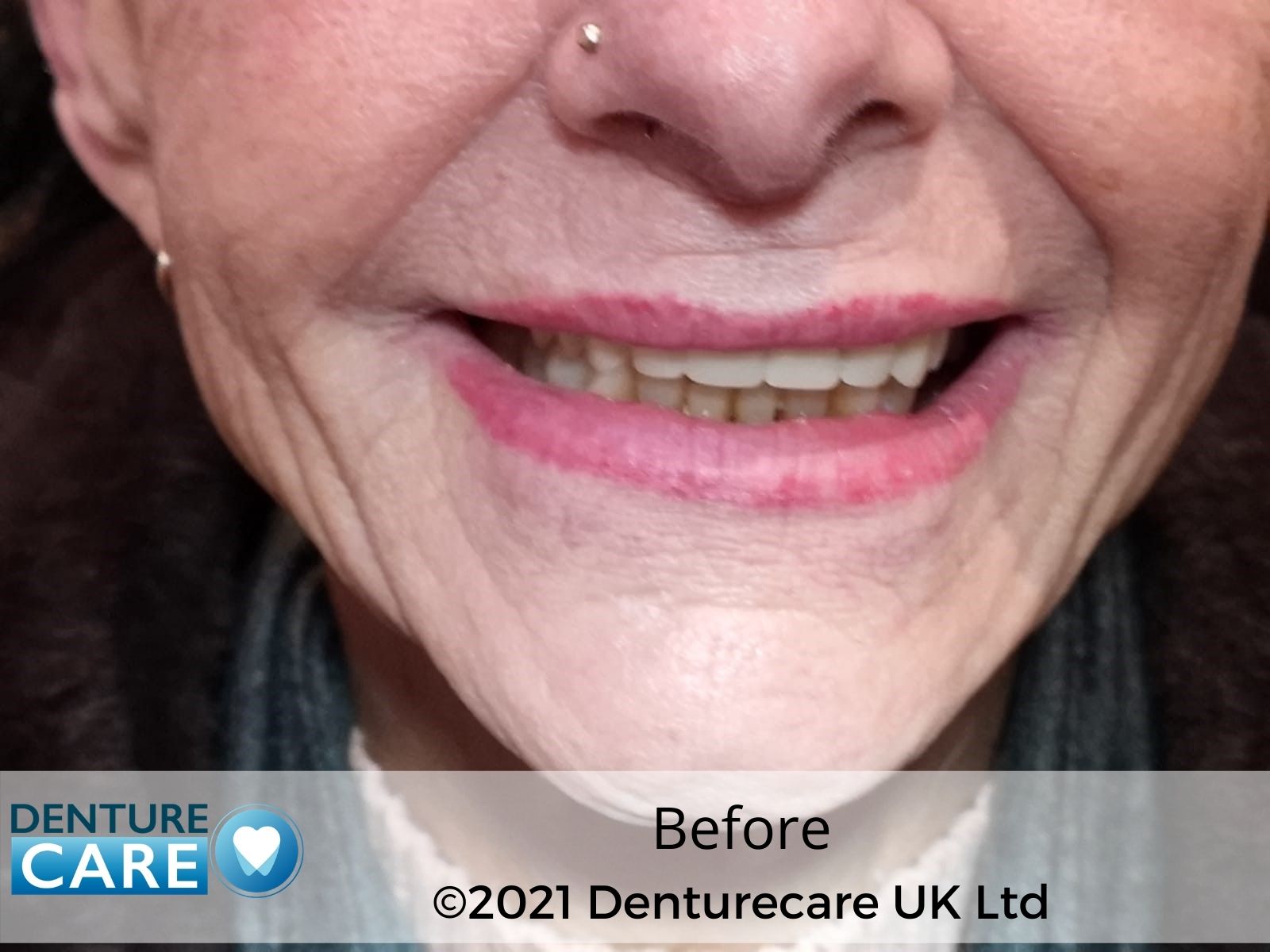 Patient’s smile before full dentures – Barnsley denture clinic