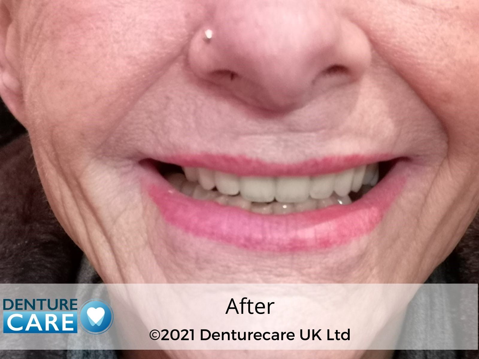 Patient’s smile after new full dentures – Barnsley denture clinic