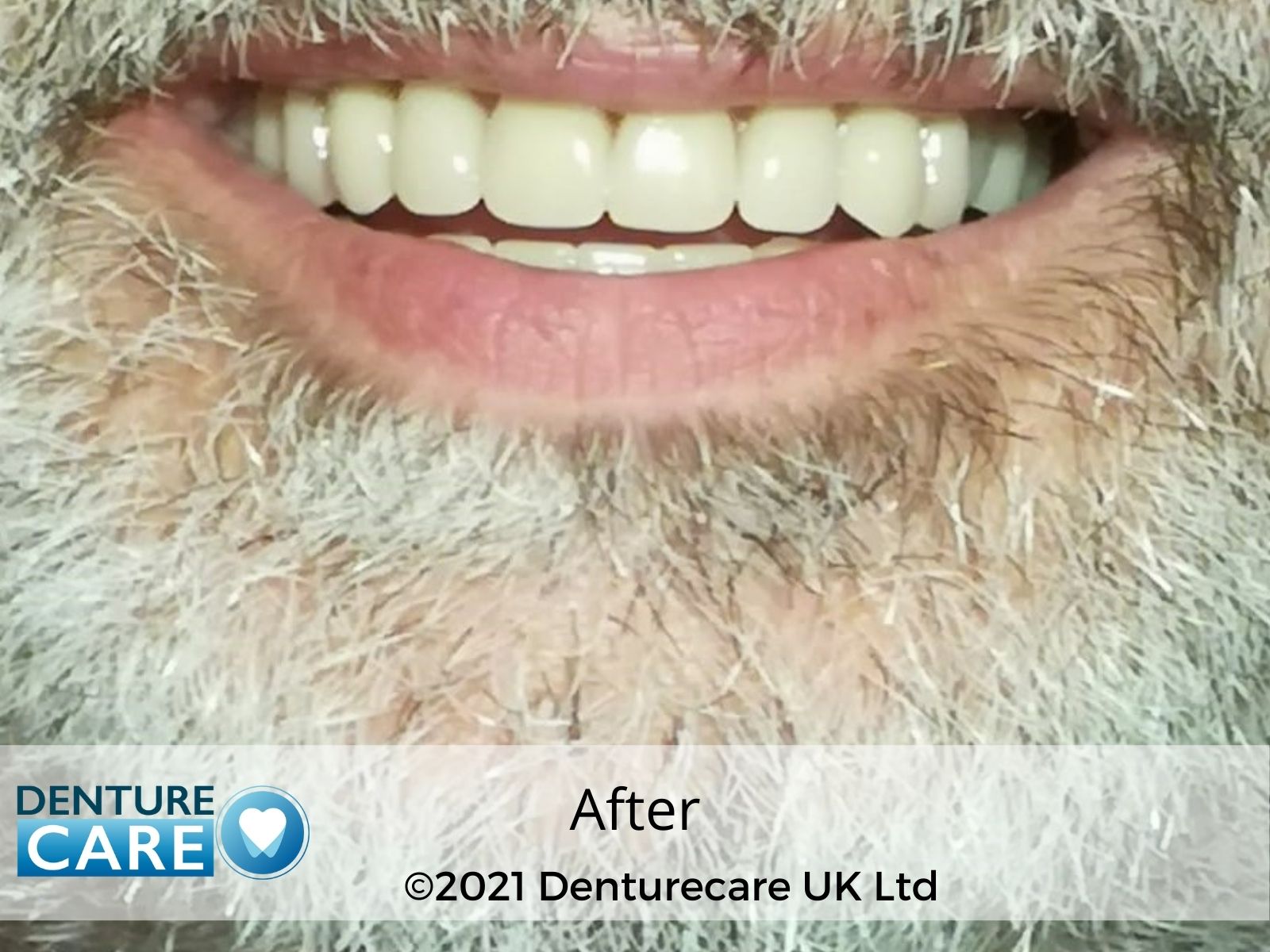 Patient’s smile after new full dentures – Barnsley denture clinic