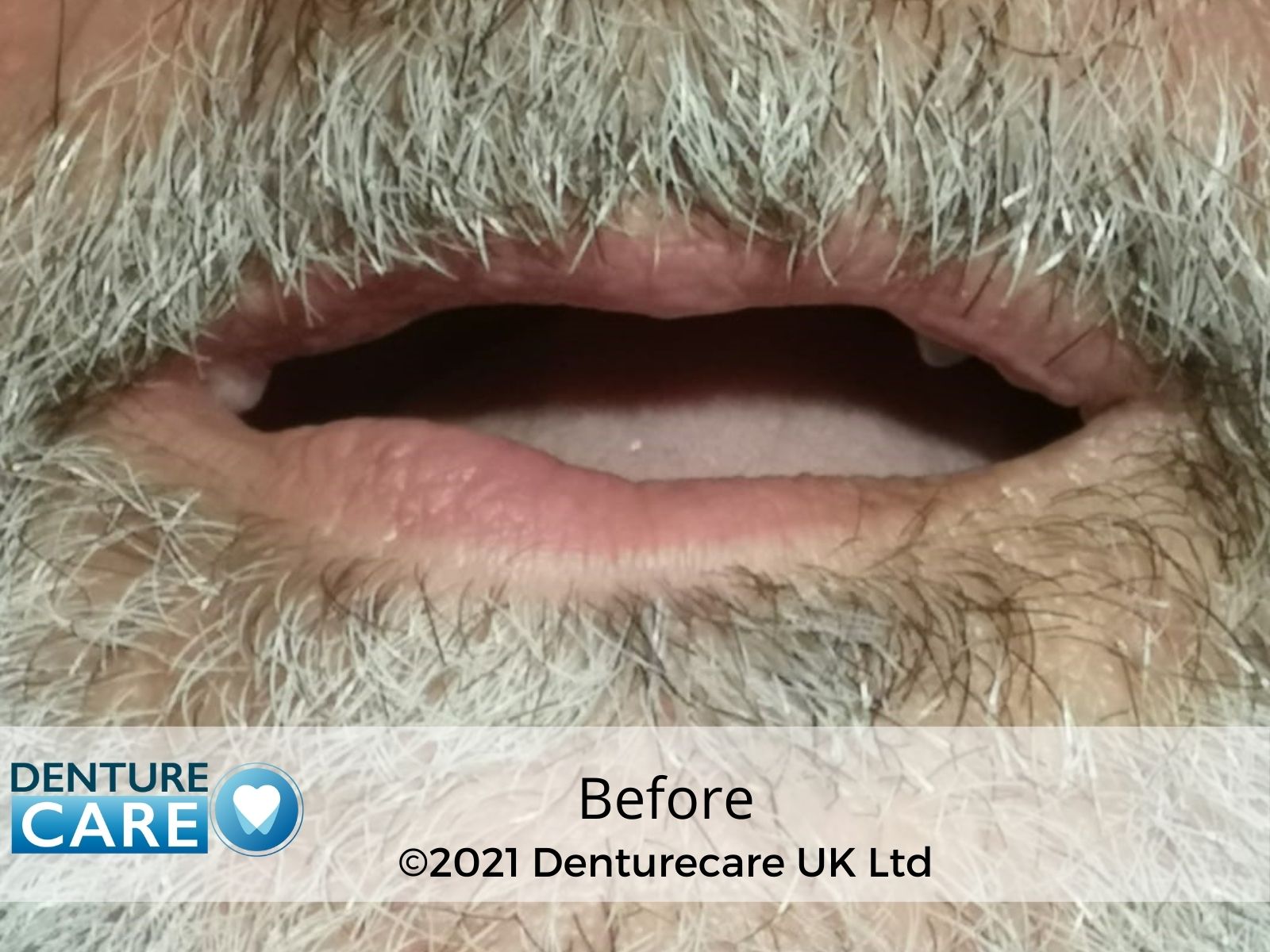 Patient’s smile before full dentures – Barnsley denture clinic