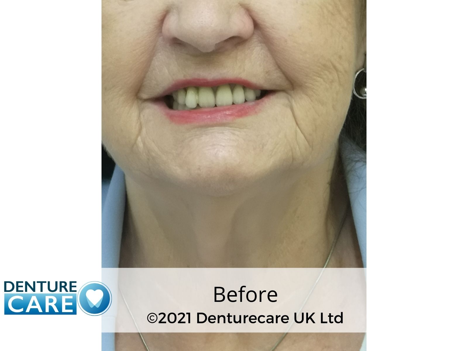 Patient’s smile before full dentures – Barnsley denture clinic