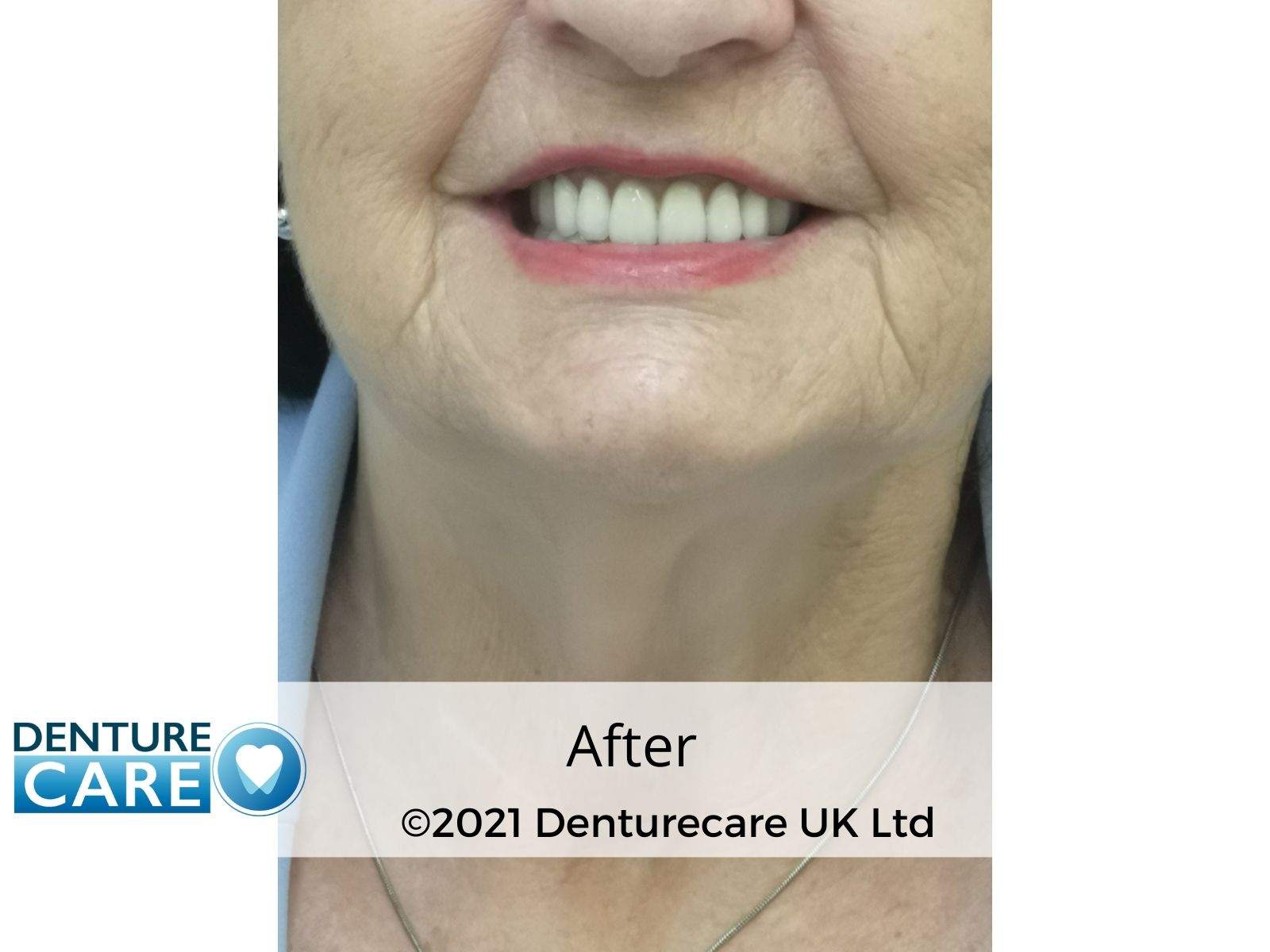 Patient’s smile after new full dentures – Barnsley denture clinic