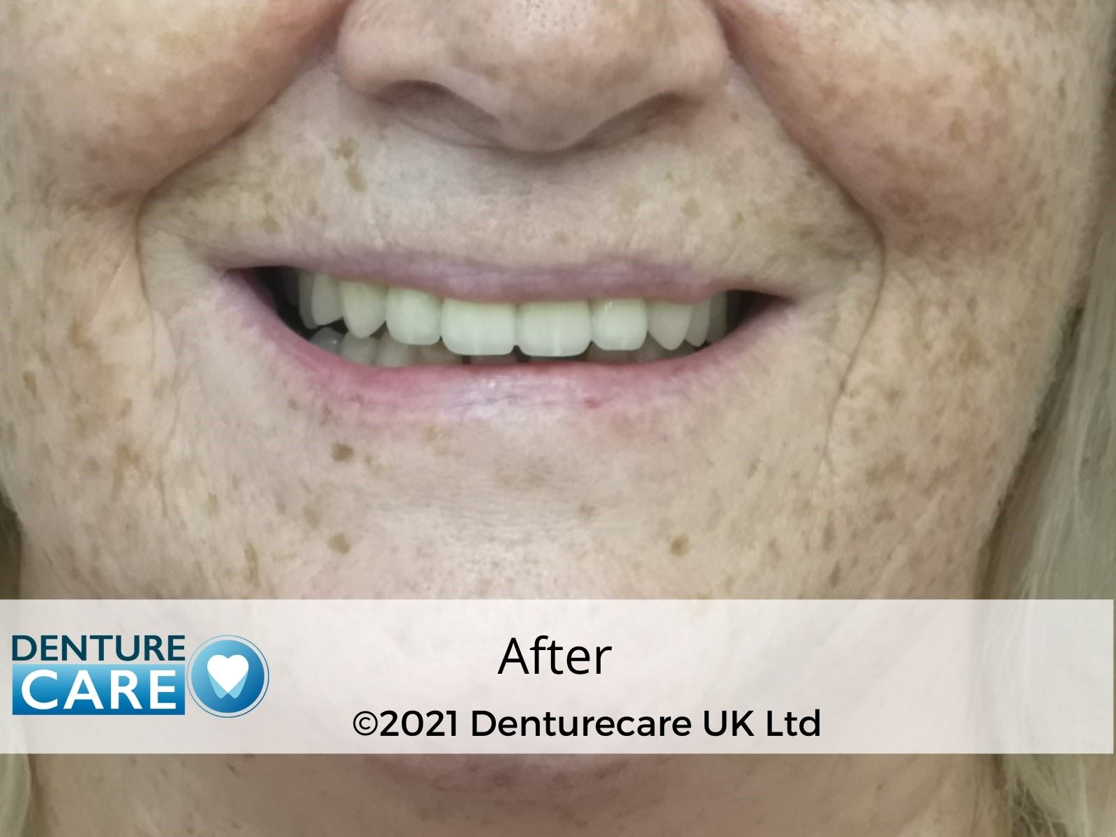 Patient’s smile after full dentures – Barnsley denture clinic