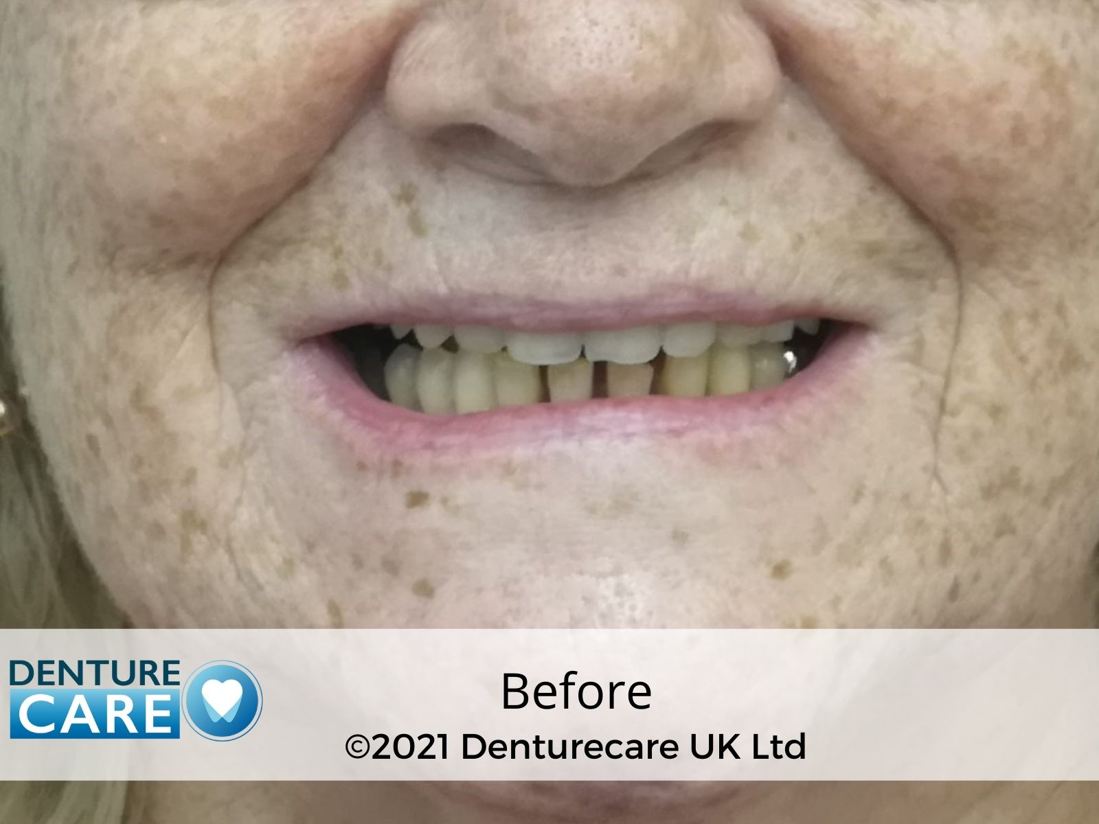 Patient’s smile before full dentures – Barnsley denture clinic