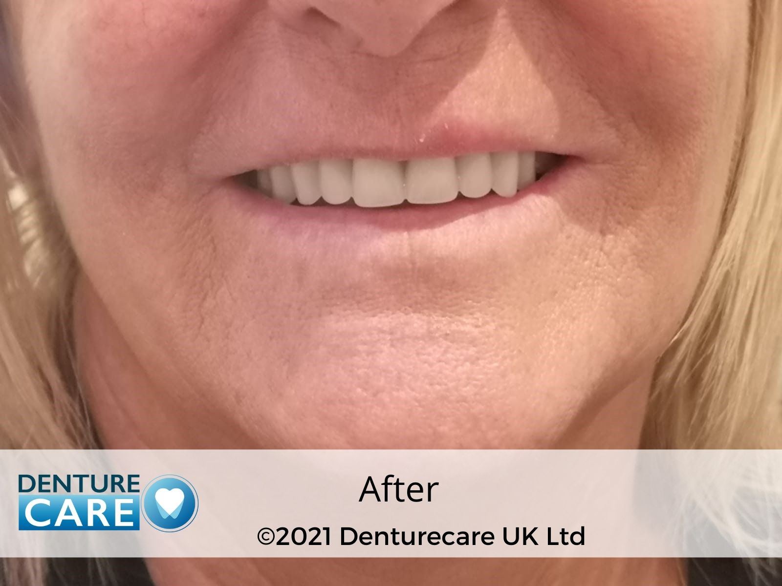 Patient’s smile after new full dentures – Barnsley denture clinic