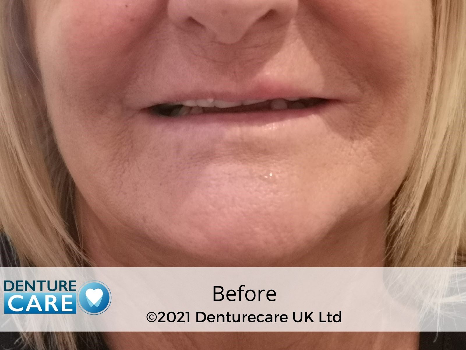 Patient’s smile before full dentures – Barnsley denture clinic
