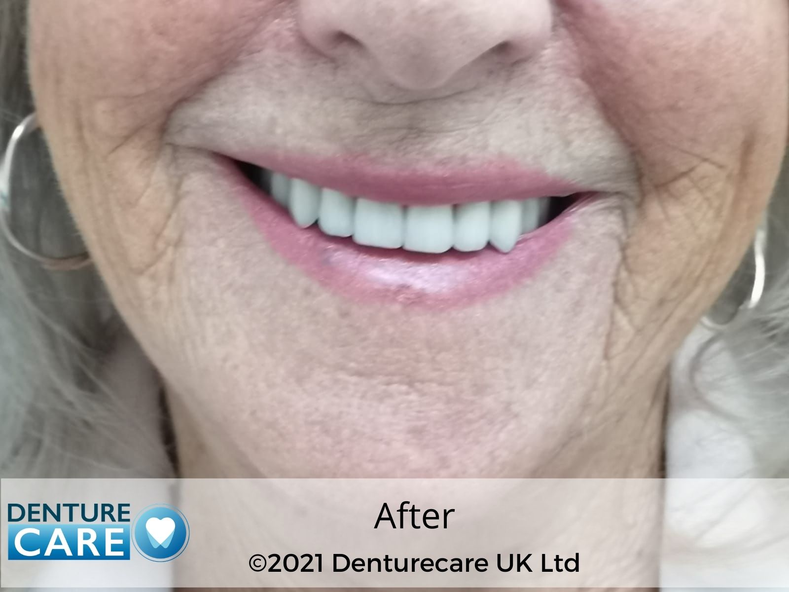 Patient’s smile after new full dentures – Doncaster denture clinic