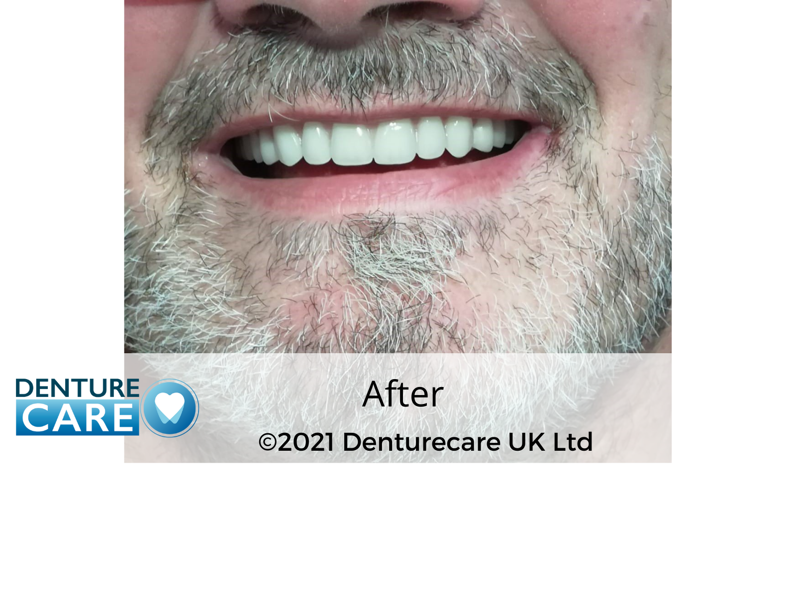 Patient’s smile after new full dentures – Barnsley denture clinic