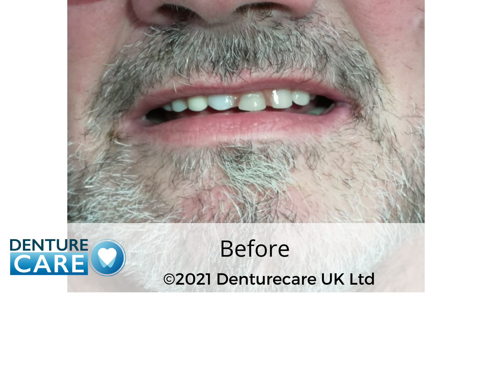 Patient’s smile before full dentures – Barnsley denture clinic