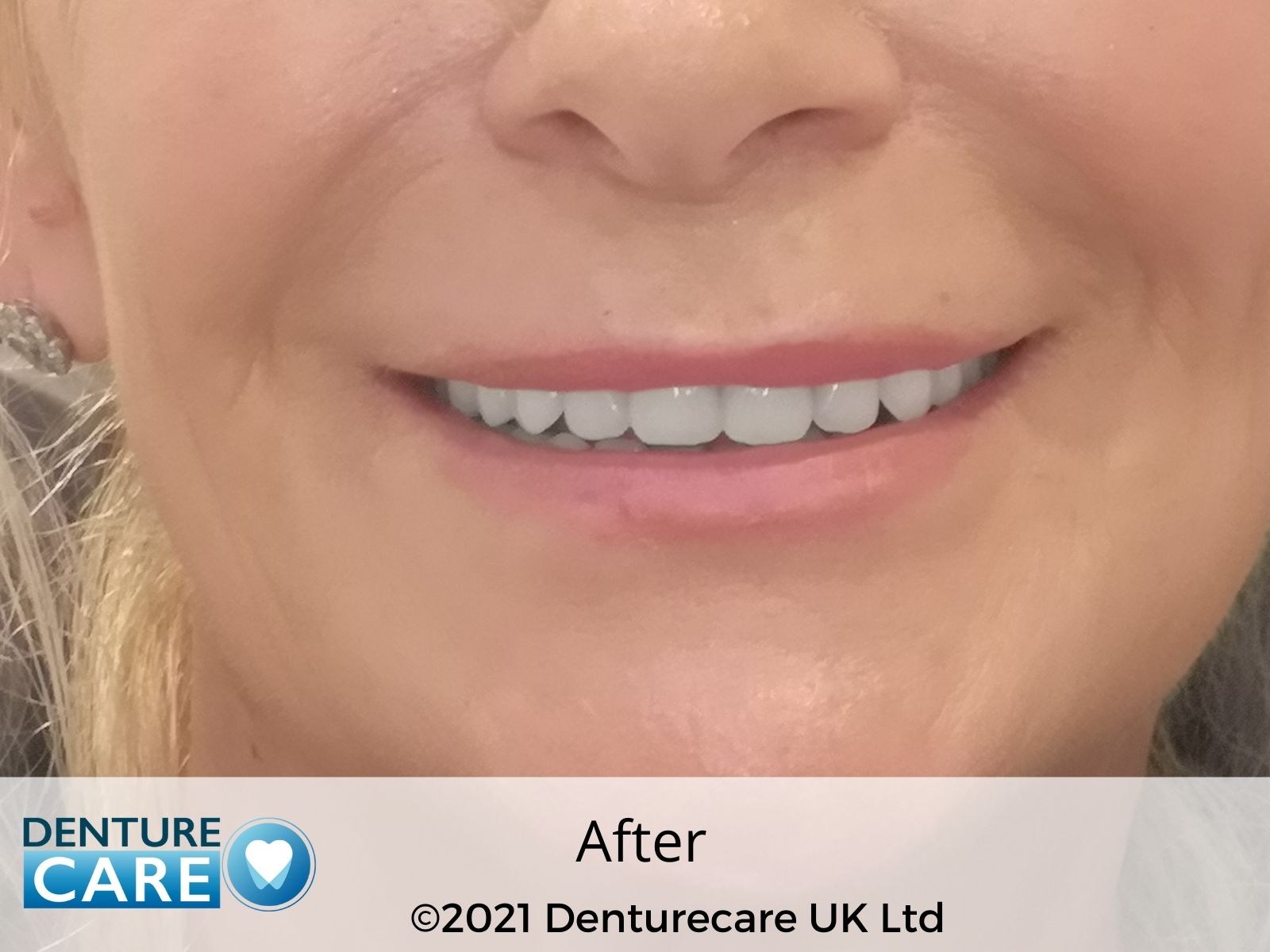 Patient’s smile after new full dentures – Doncaster denture clinic