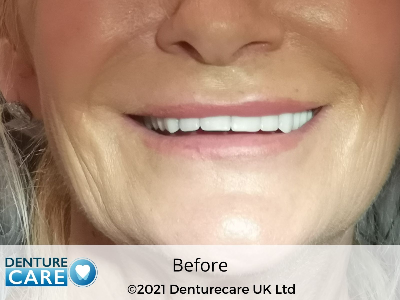 Patient’s smile before full dentures – Chesterfield denture clinic