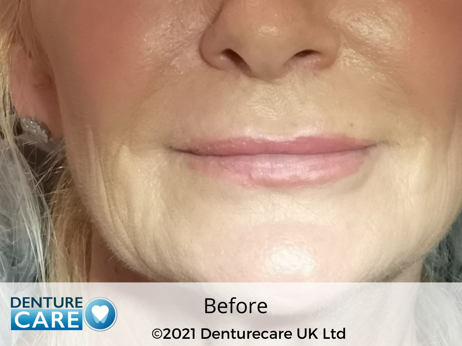 Patient’s smile before full dentures – Barnsley denture clinic