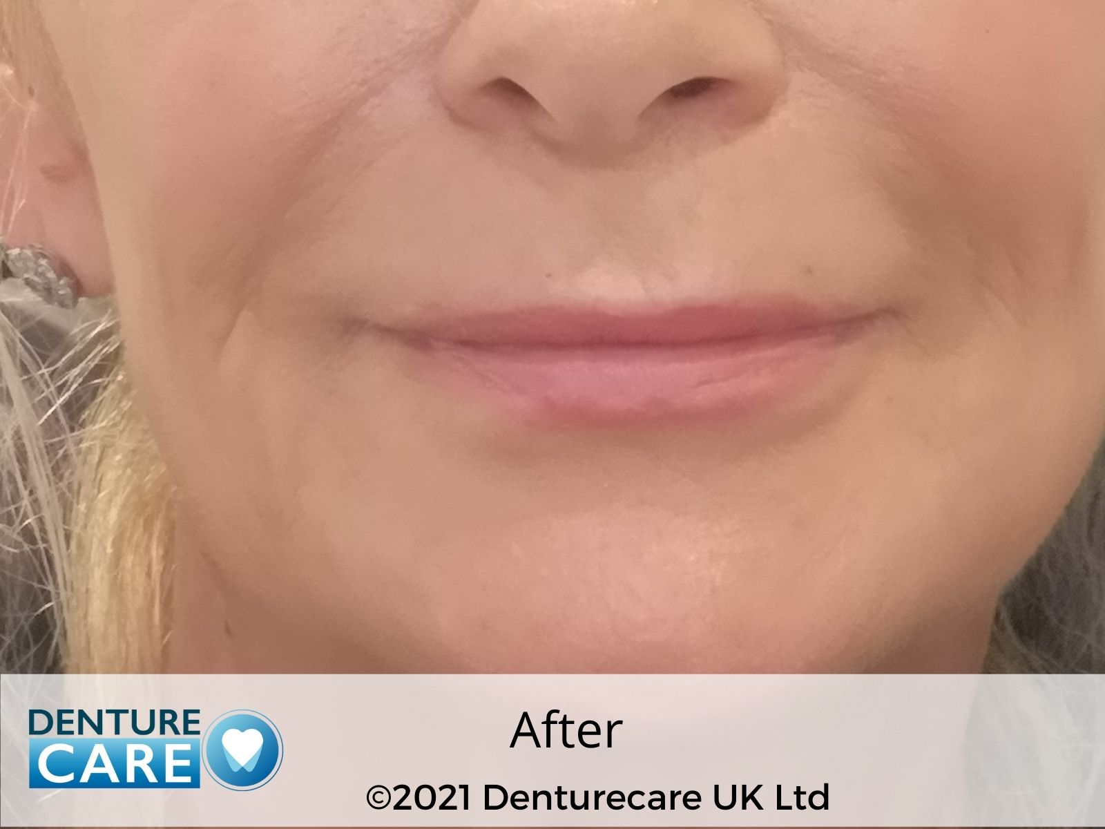 Patient’s smile after new full dentures – Barnsley denture clinic