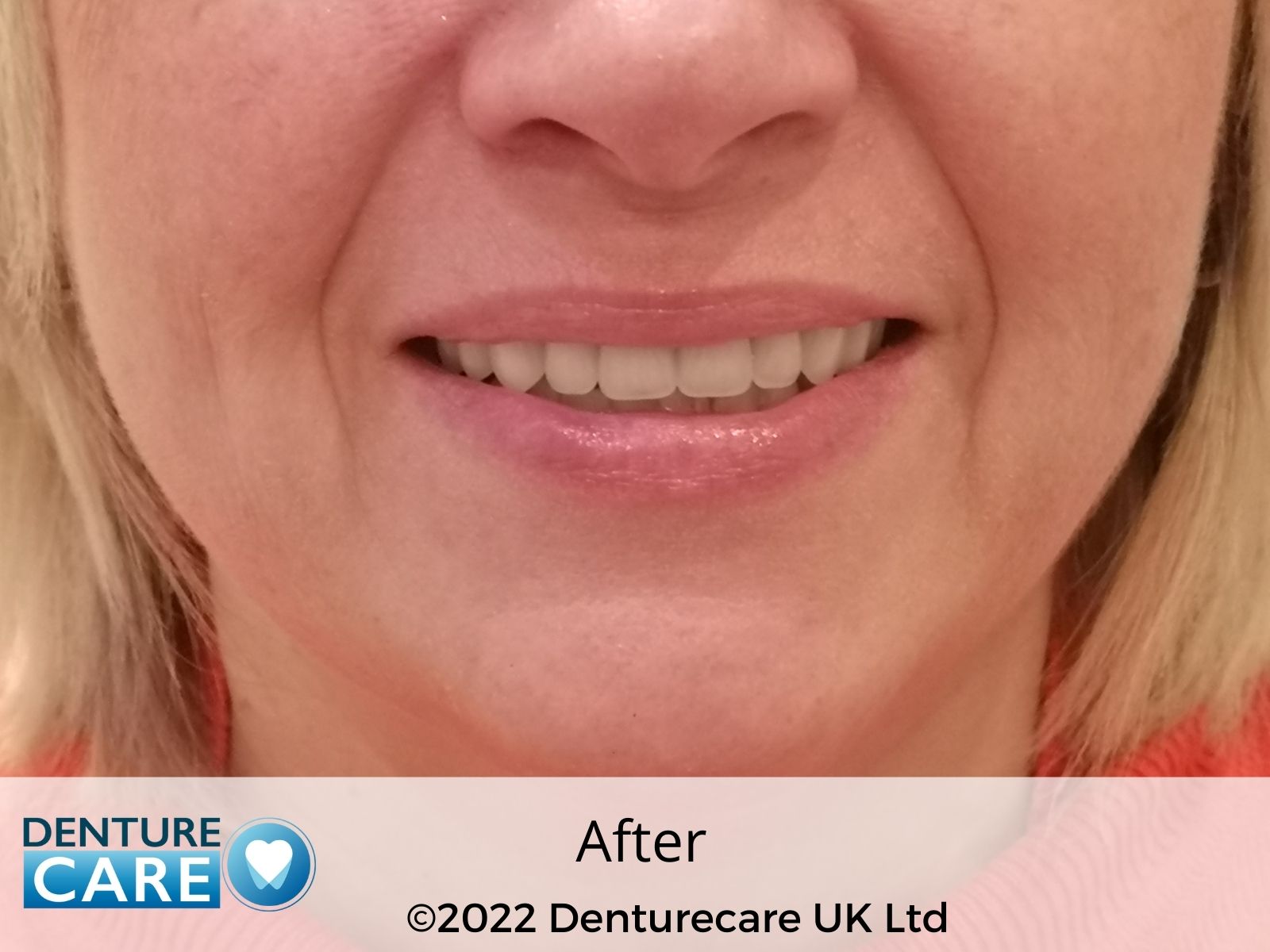 Patient’s smile after new full dentures – Doncaster denture clinic