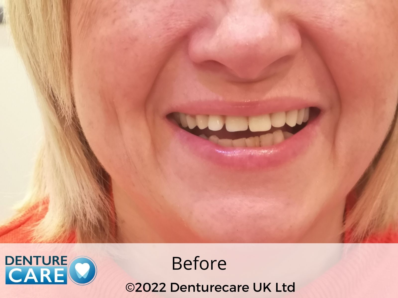 Patient’s smile before full dentures – Barnsley denture clinic