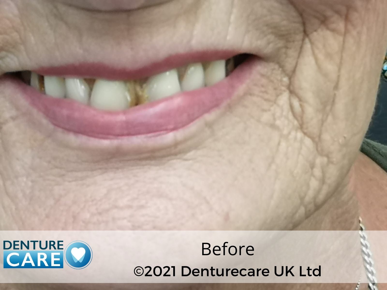 Patient’s smile before full dentures – Doncaster denture clinic
