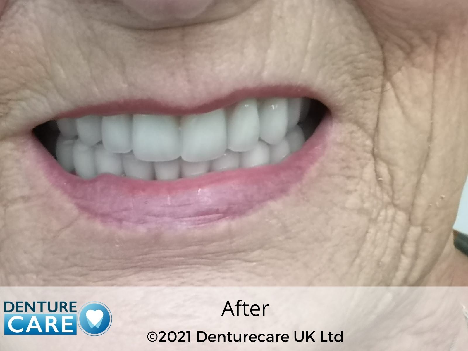 Patient’s smile after new full dentures – Doncaster denture clinic