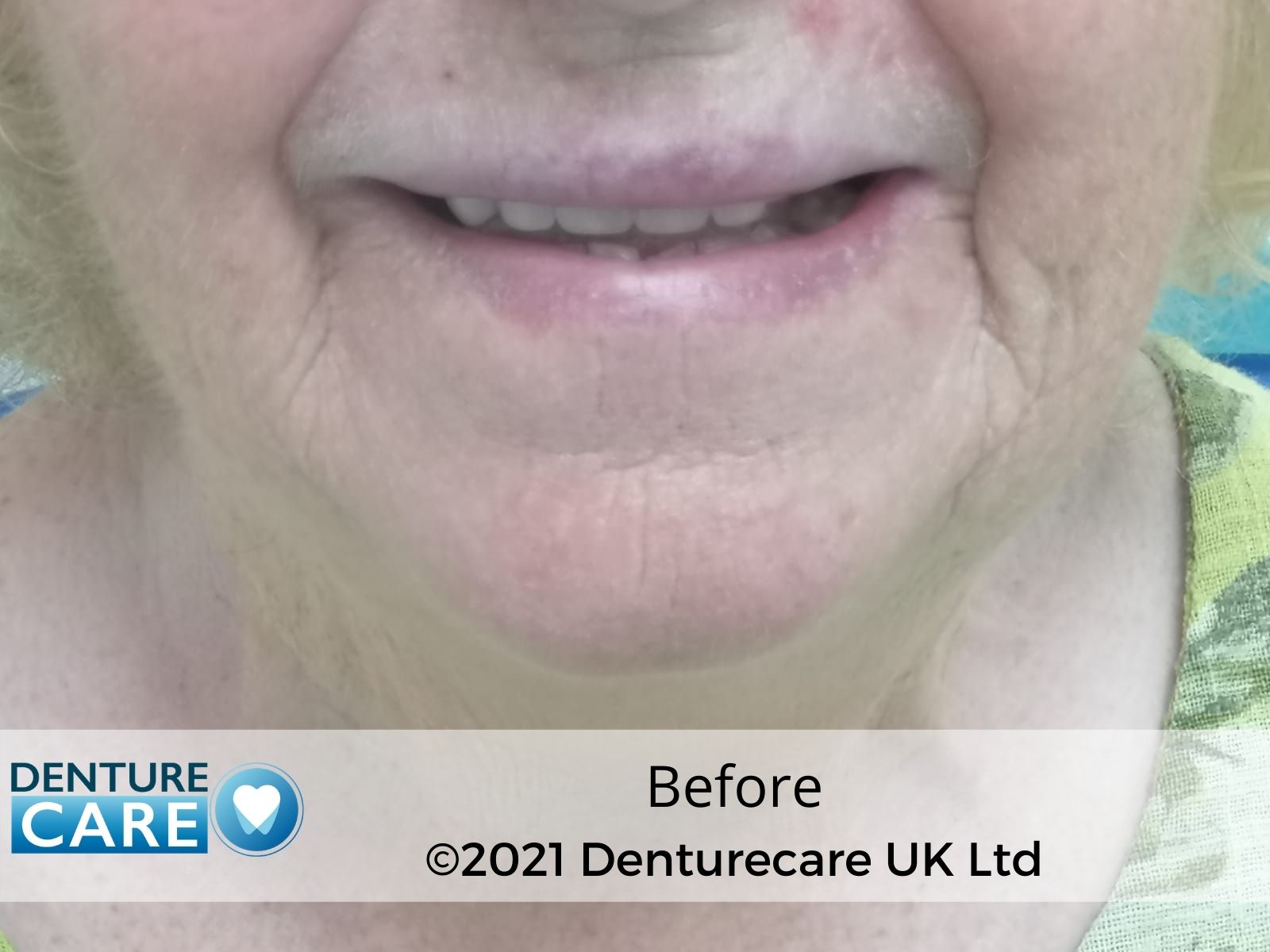 Patient’s smile before full dentures – Doncaster denture clinic