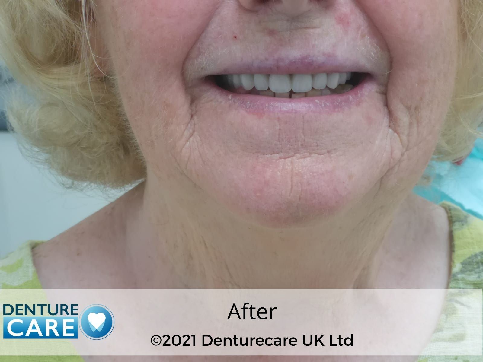 Patient’s smile after new full dentures – Doncaster denture clinic