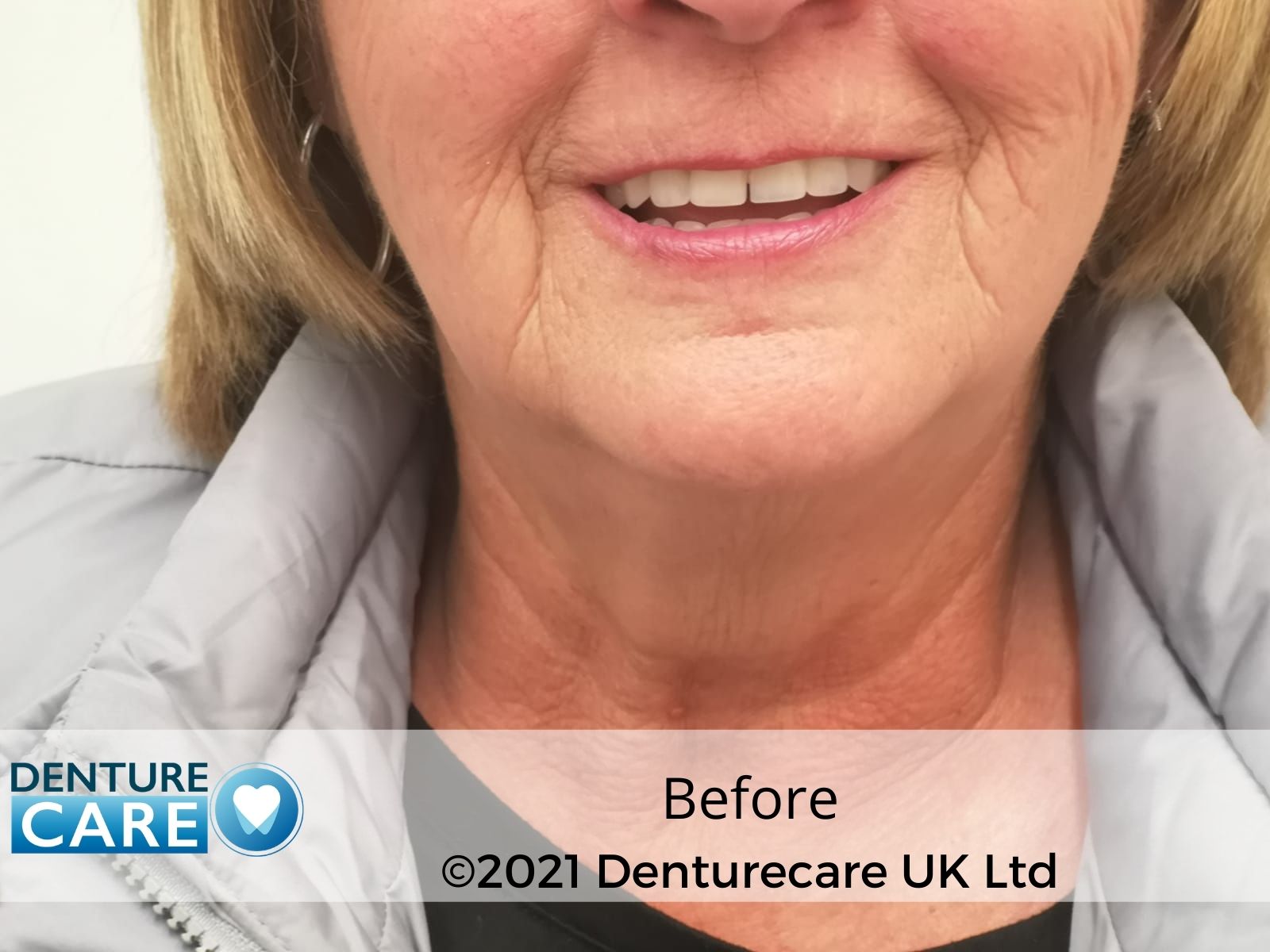 Patient’s smile before full dentures – Doncaster denture clinic