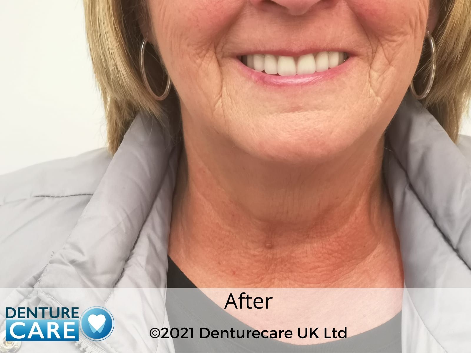 Patient’s smile after new full dentures – Doncaster denture clinic