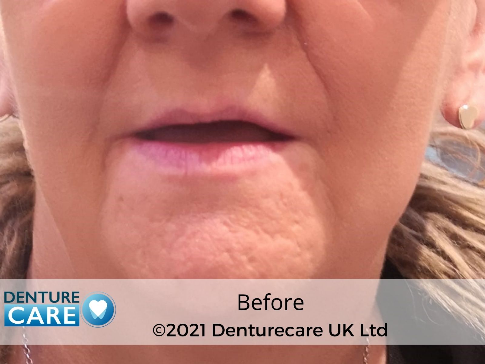 Patient’s smile before full dentures – Doncaster denture clinic