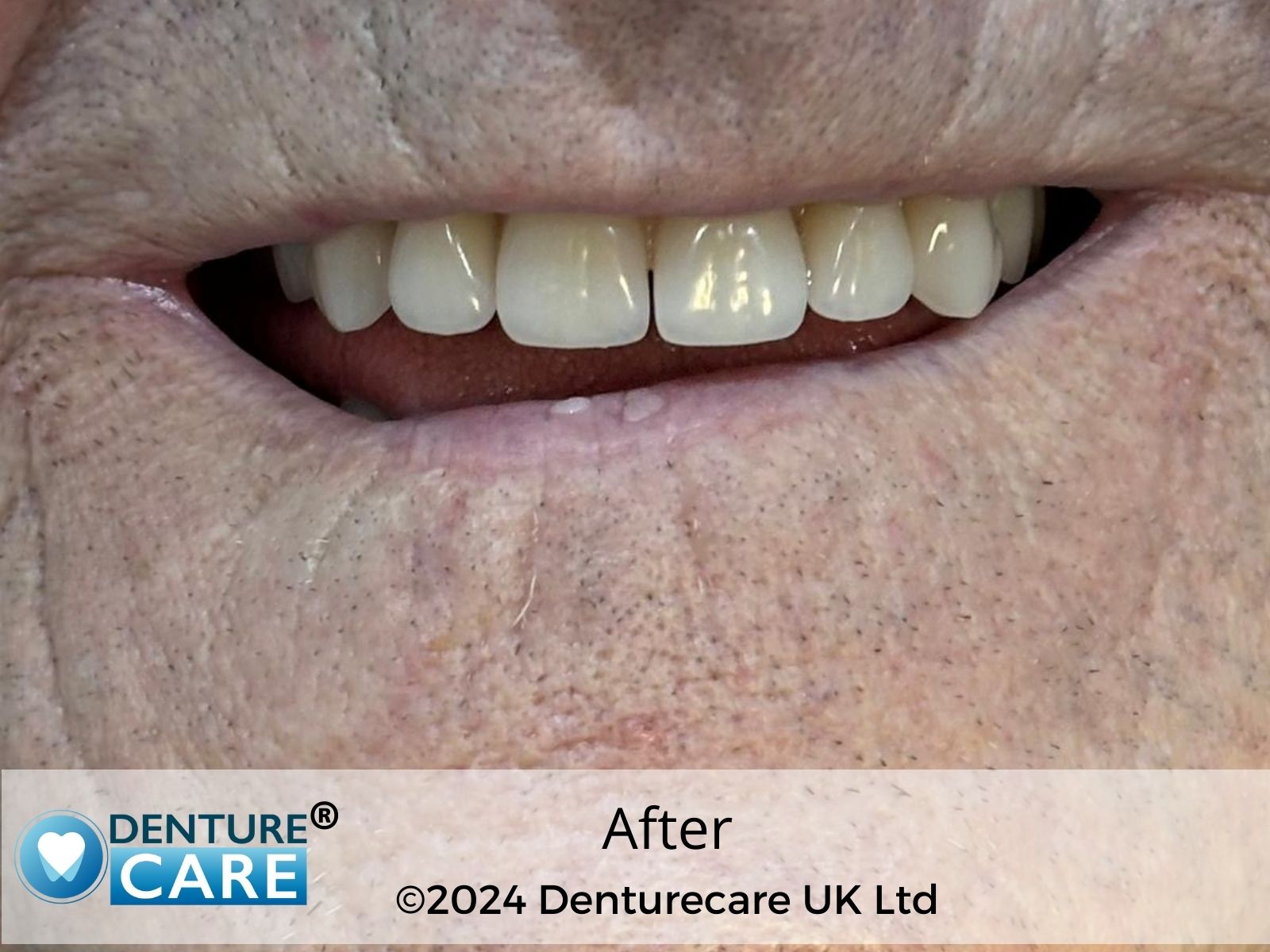 Patient’s smile after full dentures – Chesterfield denture clinic