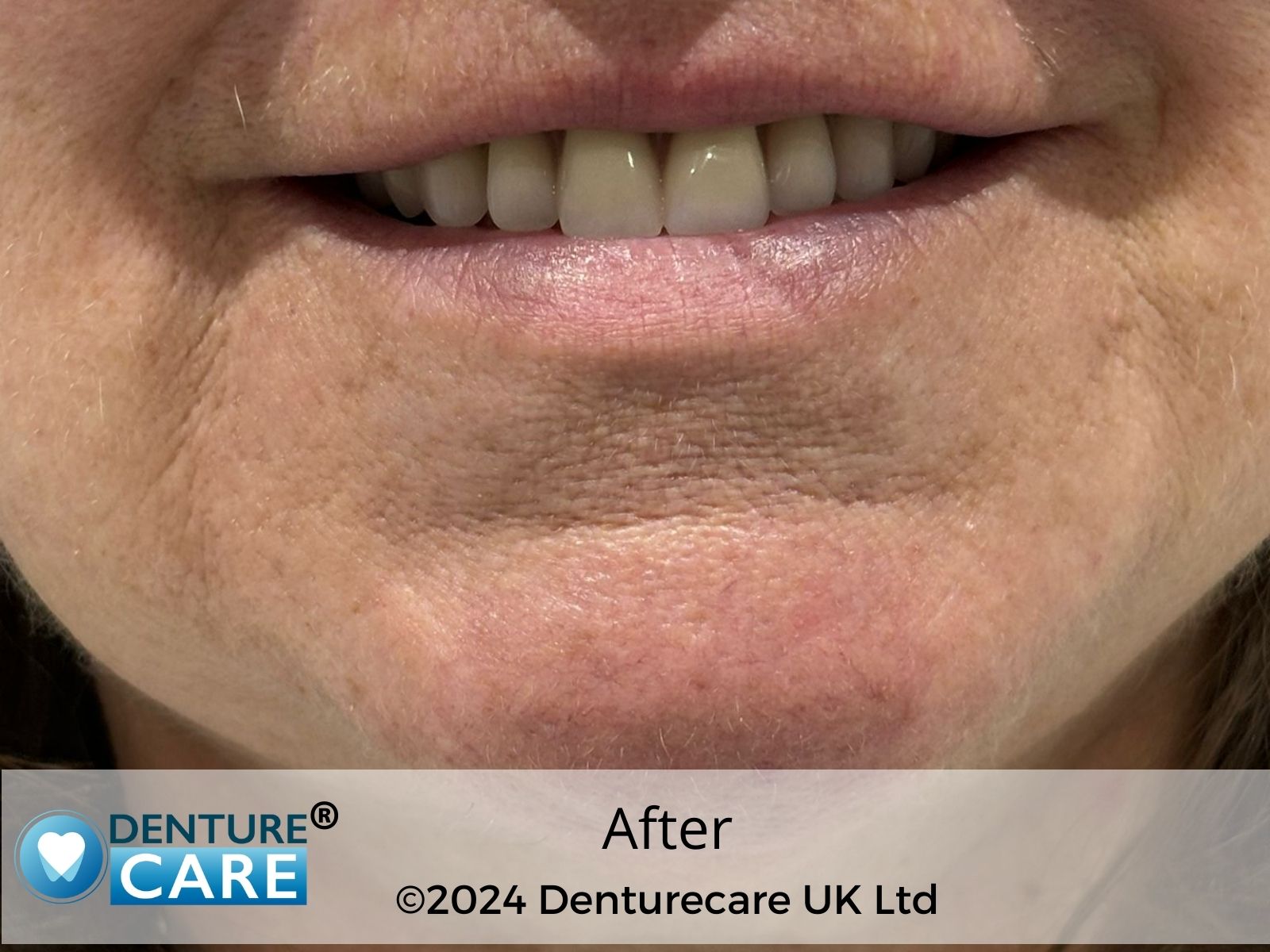 Patient’s smile after full dentures –Doncaster denture clinic