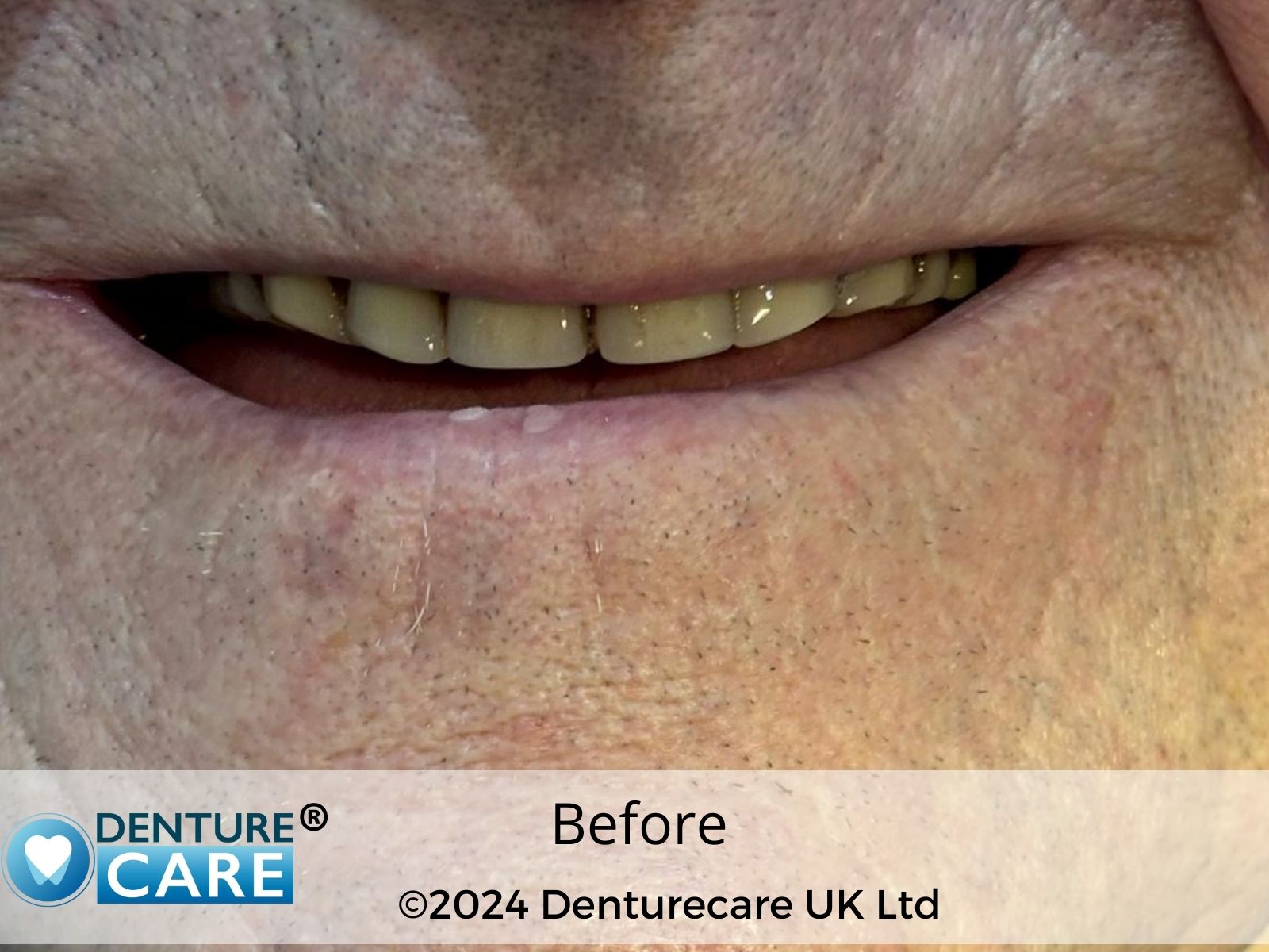 Patient’s smile before full dentures – Chesterfield denture clinic