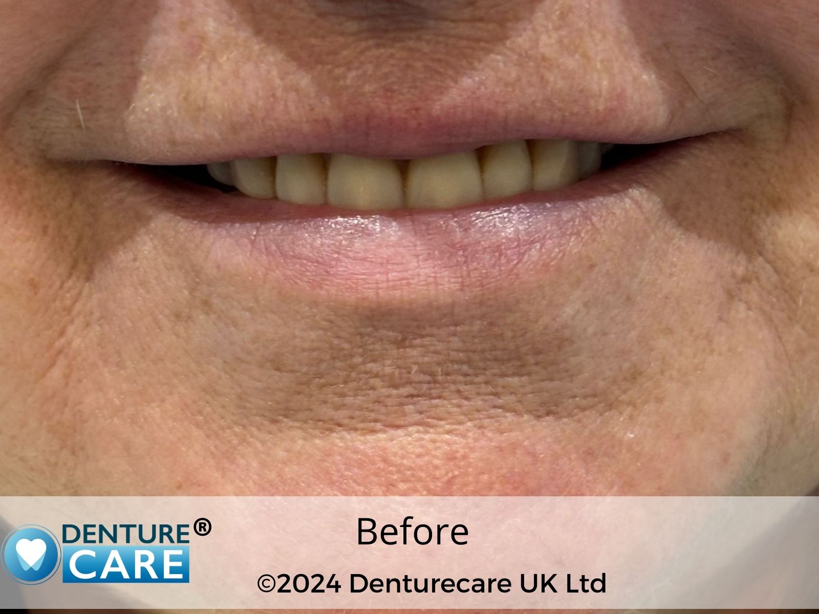 Patient’s smile before full dentures – Doncaster denture clinic