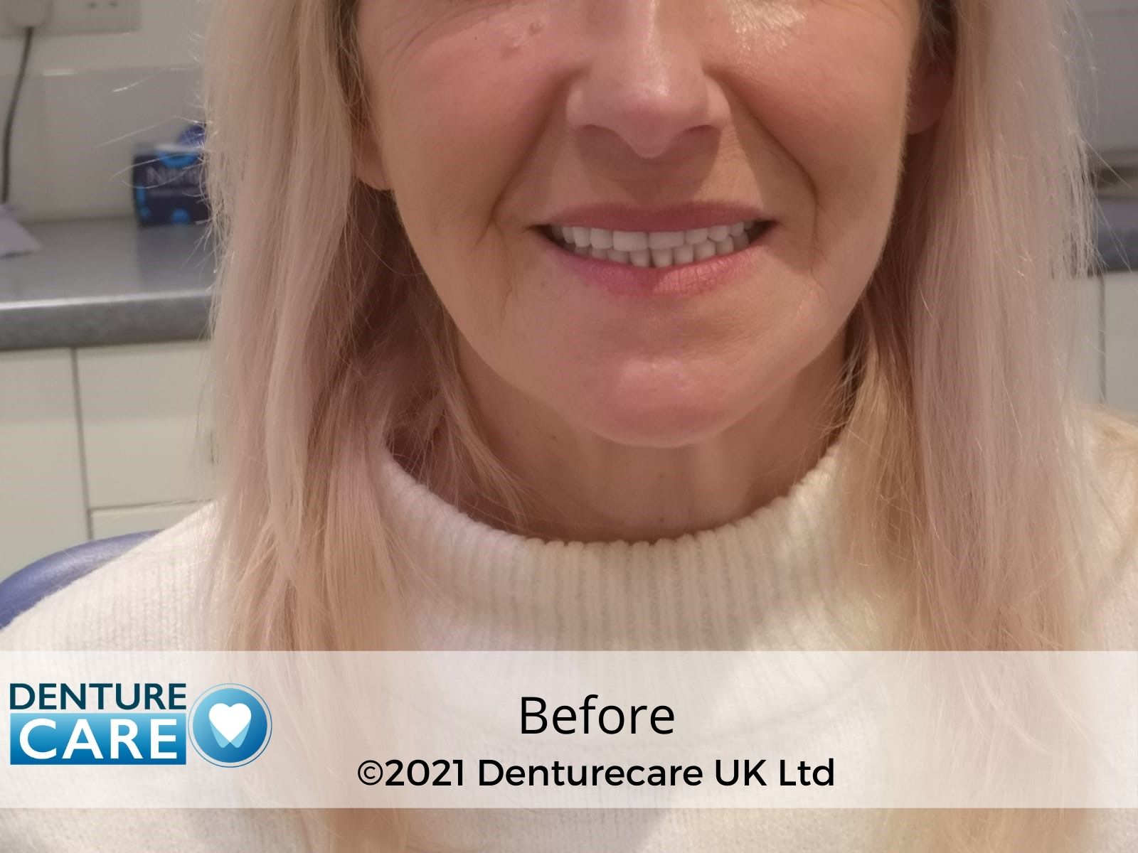 Patient’s smile before full dentures – Doncaster denture clinic