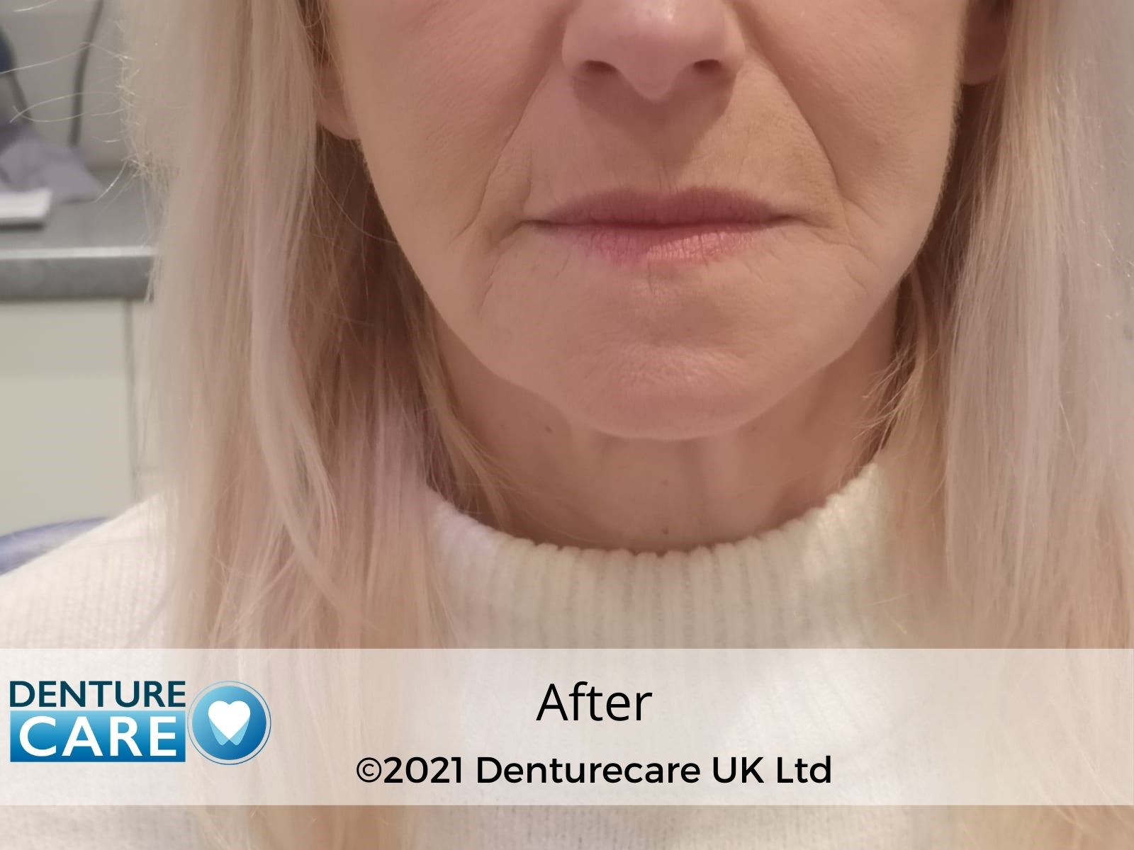 Patient’s smile after full dentures – Doncaster denture clinic