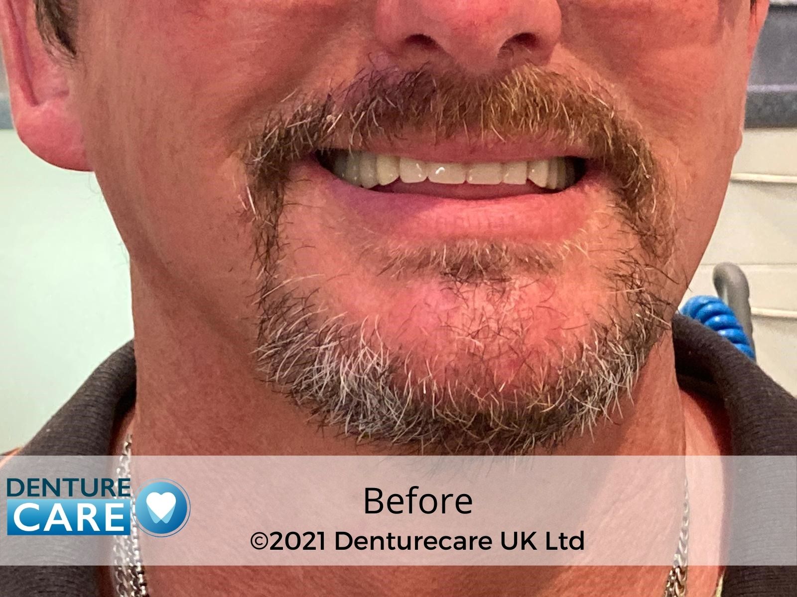 Patient’s smile before full dentures – Chesterfield denture clinic