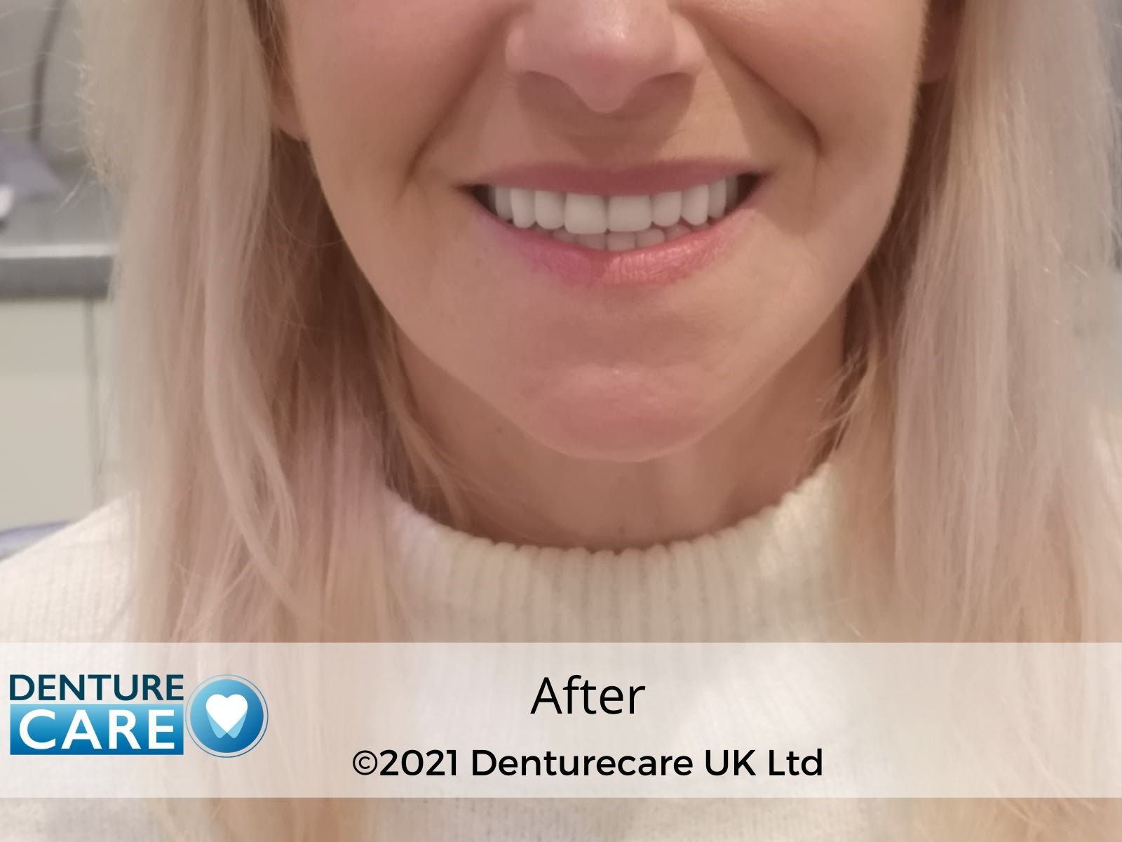 Dentures Before and After photos