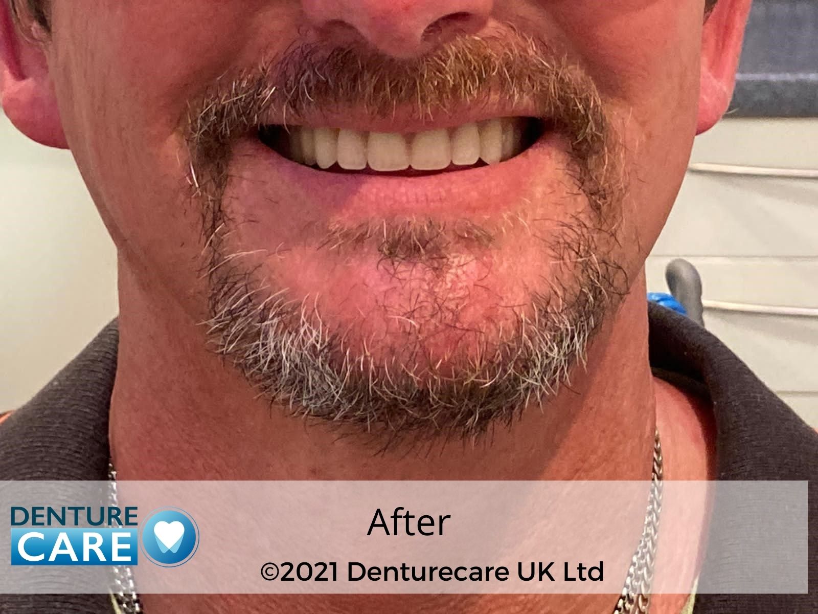 Patient’s smile before full dentures – Doncaster denture clinic